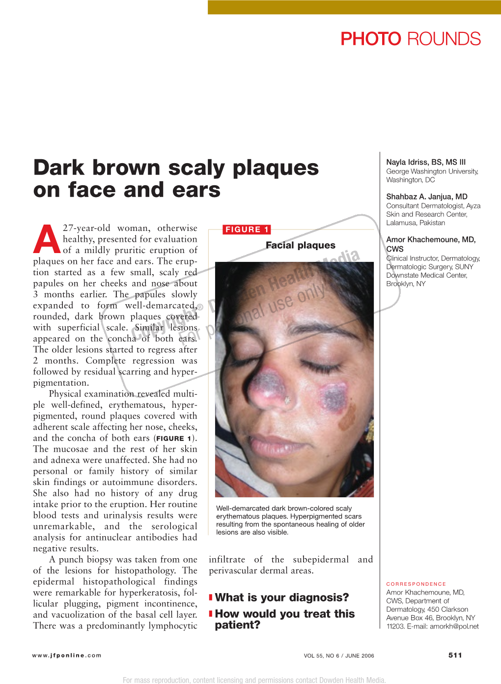 Dark Brown Scaly Plaques on Face and Ears