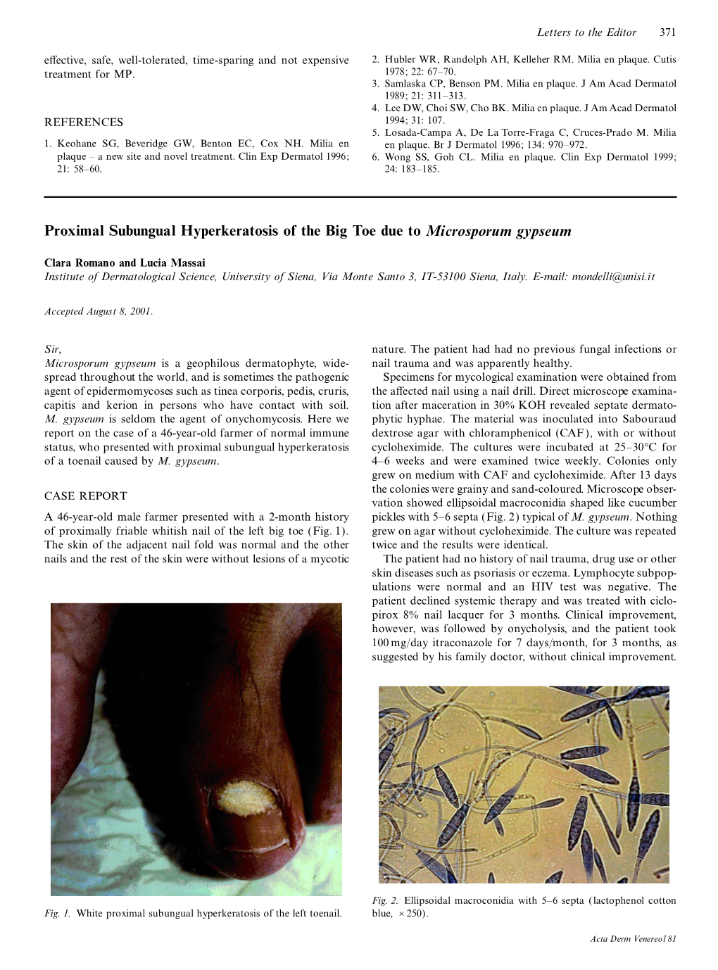 Proximal Subungual Hyperkeratosis of the Big Toe Due to Microsporum Gypseum