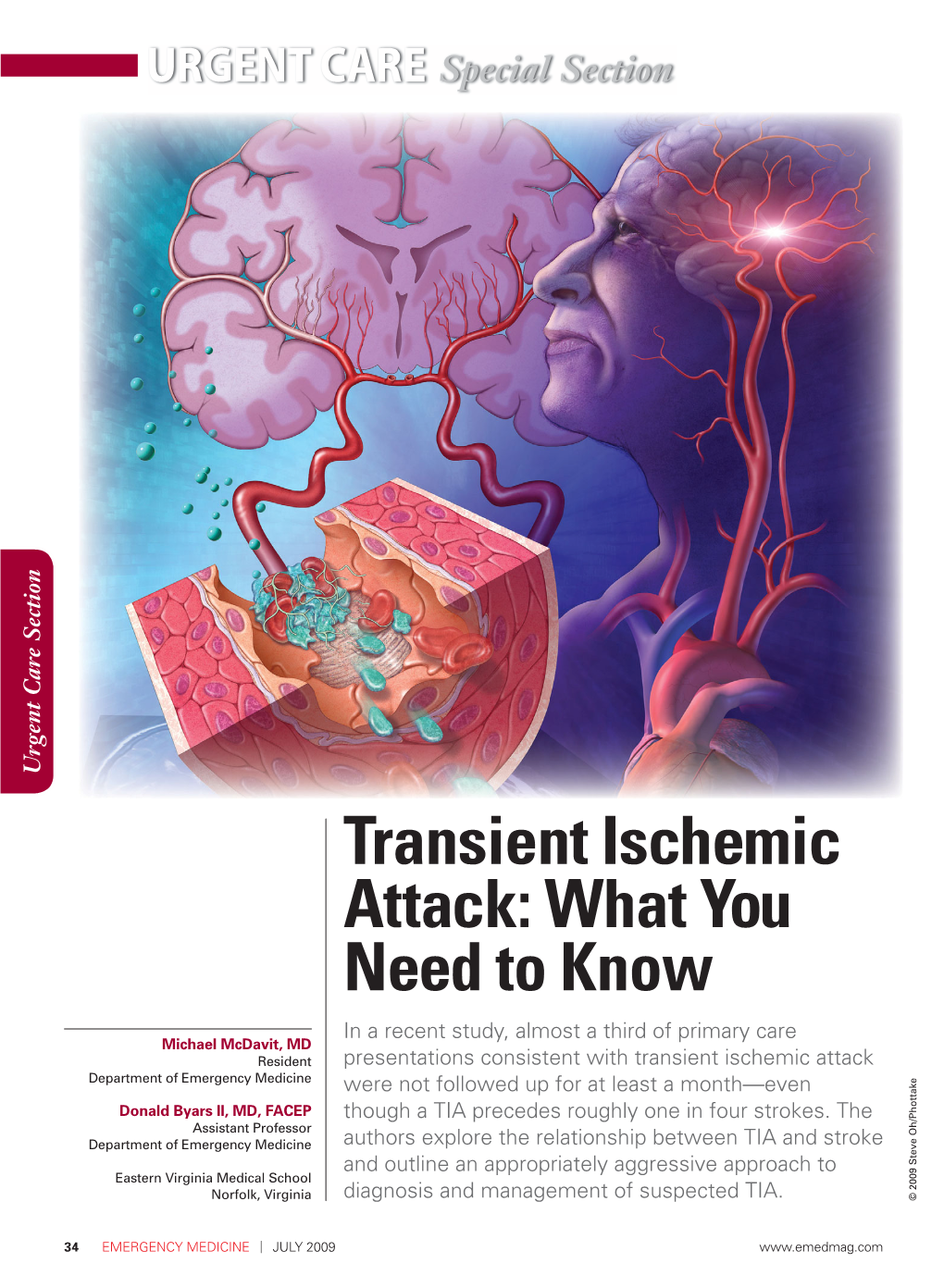 Transientischemic Attack:Whatyou Needto Know