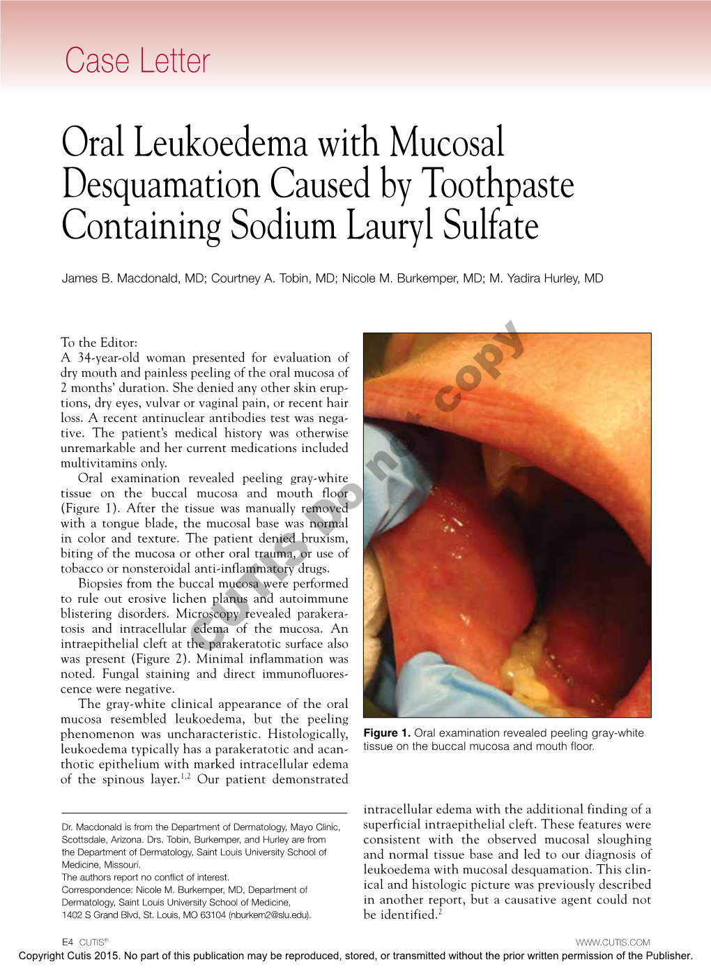 Oral Leukoedema with Mucosal Desquamation Caused by Toothpaste Containing Sodium Lauryl Sulfate