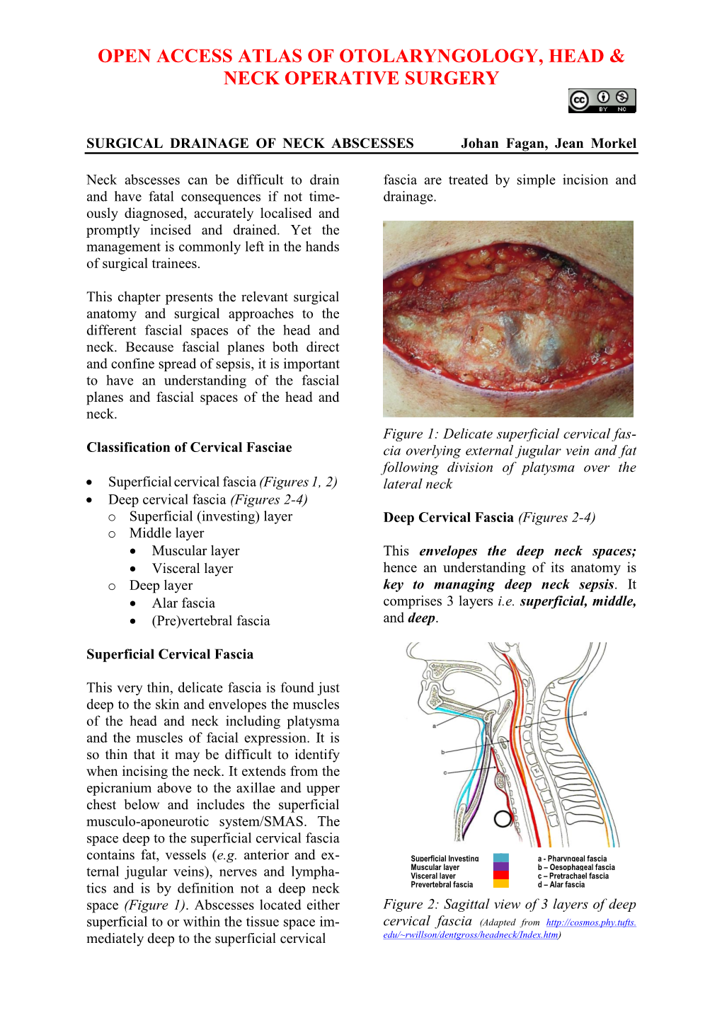 SURGICAL DRAINAGE of NECK ABSCESSES Johan Fagan, Jean Morkel