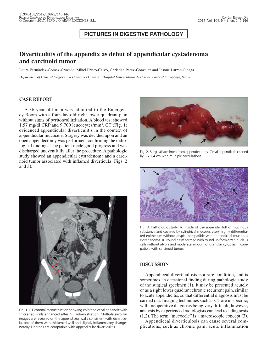 Diverticulitis of the Appendix As Debut of Appendicular Cystadenoma And