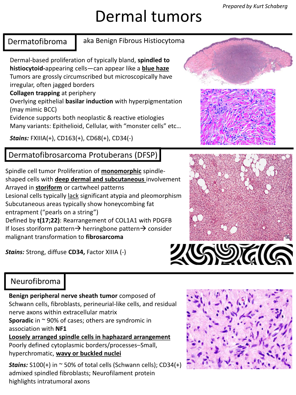 Dermal Tumors Dermatofibroma Aka Benign Fibrous Histiocytoma