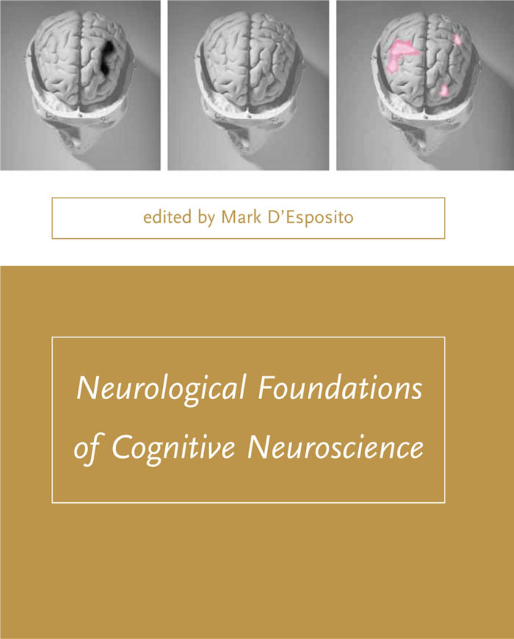 2 Bálint's Syndrome: a Disorder of Visual Cognition