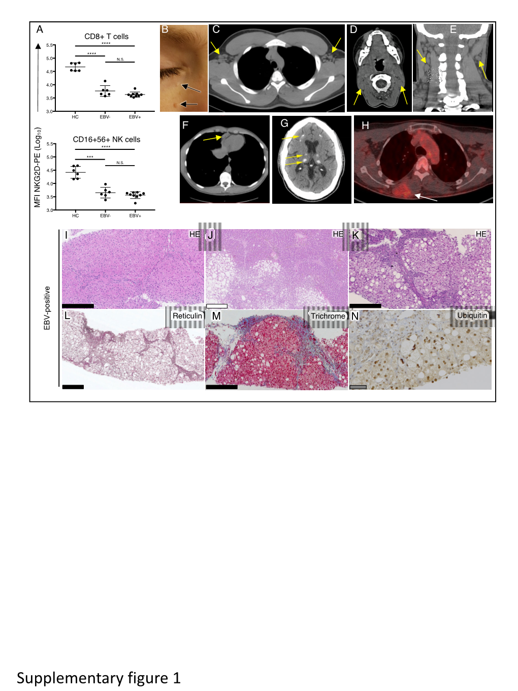 Supplementary Figure 1 EBV- EBV+