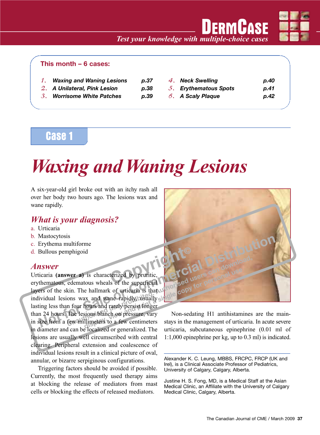 Waxing and Waning Lesions P.37 4