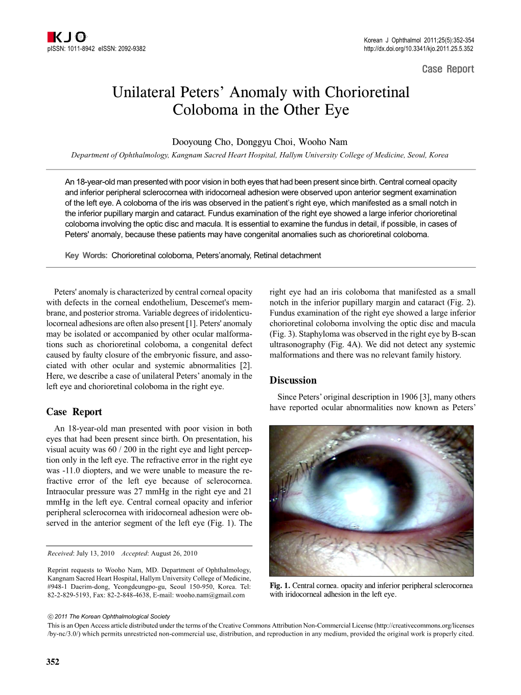 Unilateral Peters' Anomaly with Chorioretinal Coloboma in The