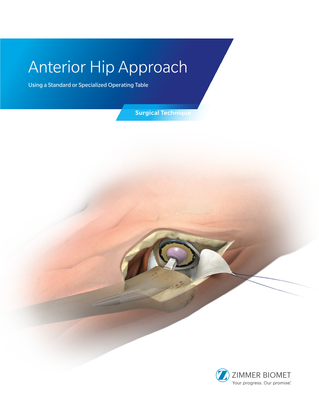 Anterior Hip Approach Using a Standard Or Specialized Operating Table