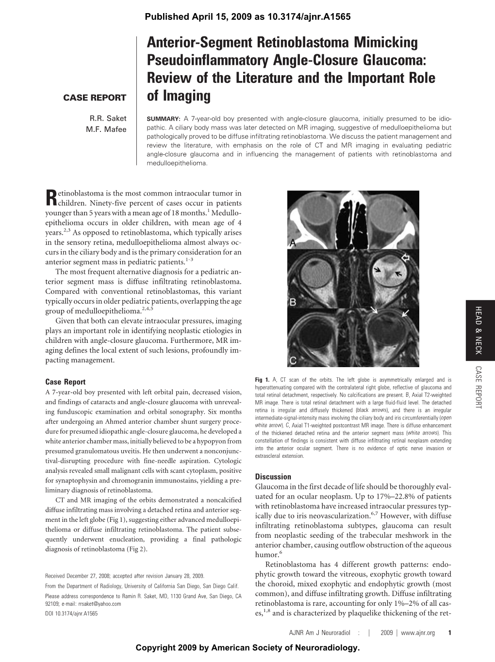 Anterior-Segment Retinoblastoma Mimicking Pseudoinflammatory Angle-Closure Glaucoma: Review of the Literature and the Important Role CASE REPORT of Imaging