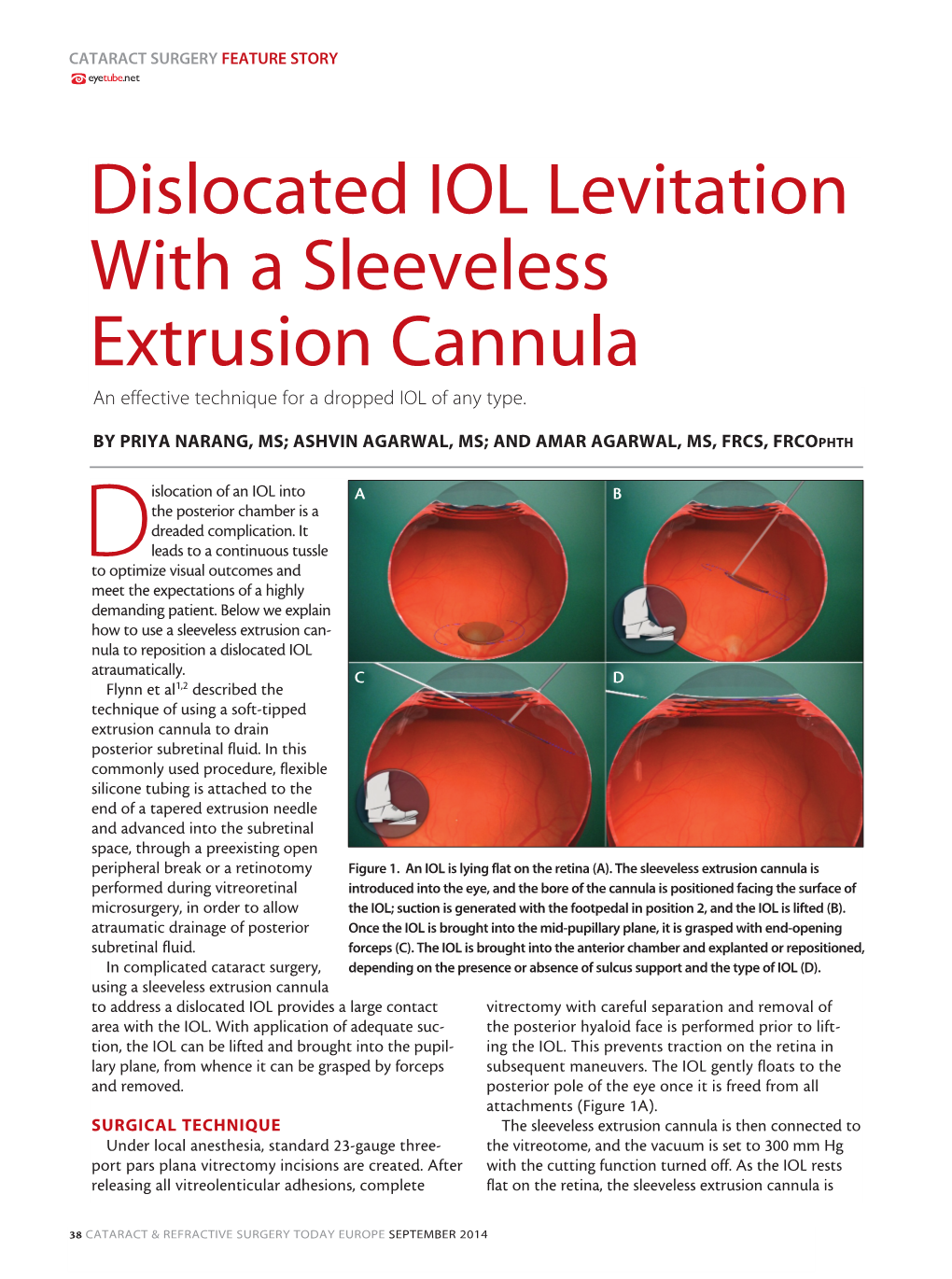 Dislocated IOL Levitation with a Sleeveless Extrusion Cannula an Effective Technique for a Dropped IOL of Any Type