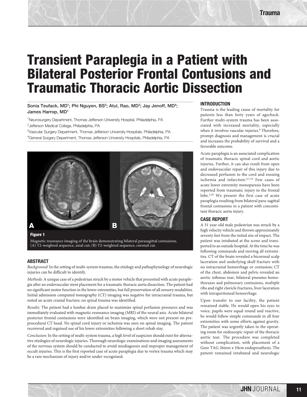 Transient Paraplegia in a Patient with Bilateral Posterior Frontal Contusions and Traumatic Thoracic Aortic Dissection