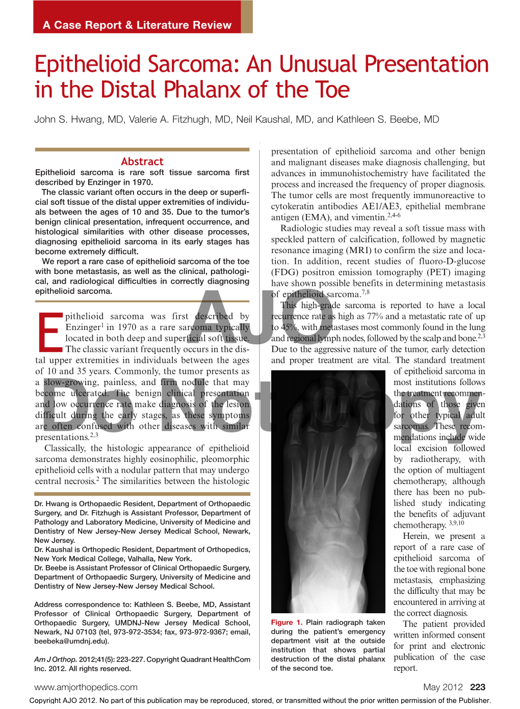 Epithelioid Sarcoma: an Unusual Presentation in the Distal Phalanx of the Toe