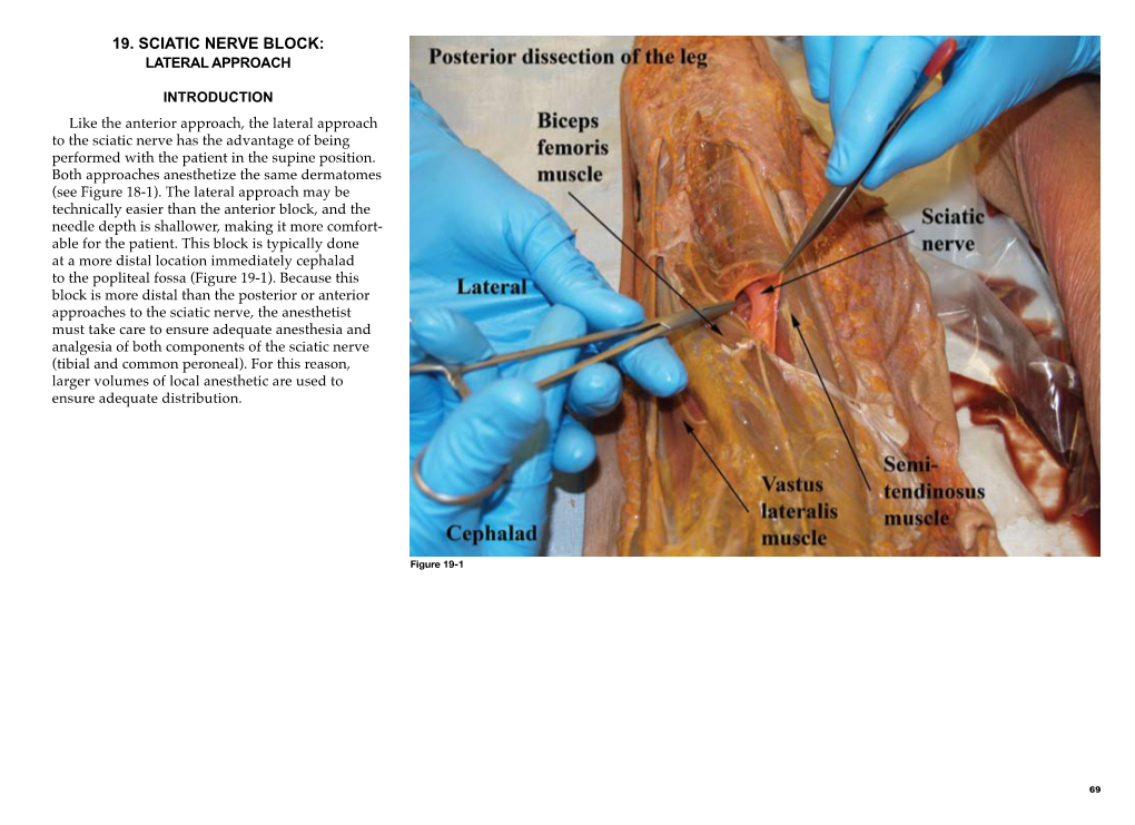 Sciatic Nerve Block: Lateral Approach