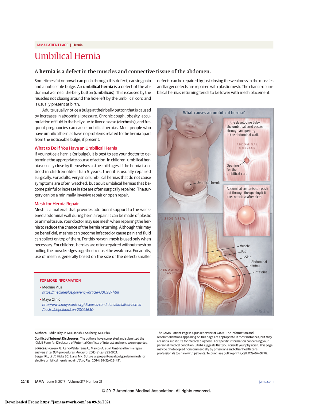 Umbilical Hernia