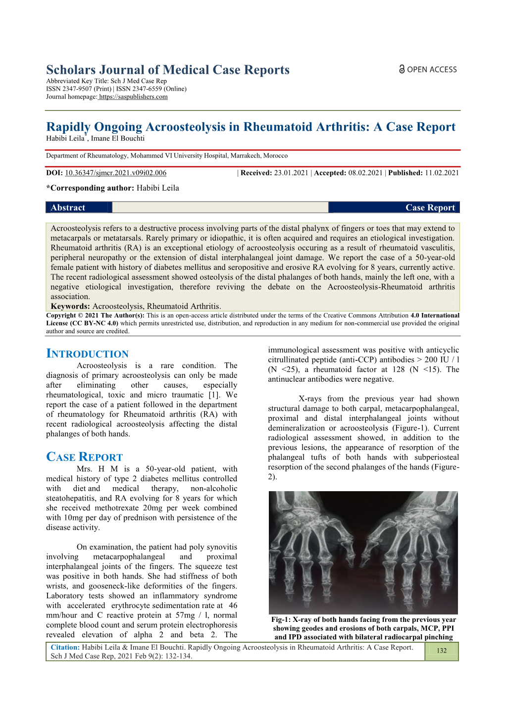 Rapidly Ongoing Acroosteolysis in Rheumatoid Arthritis: a Case Report Habibi Leila*, Imane El Bouchti