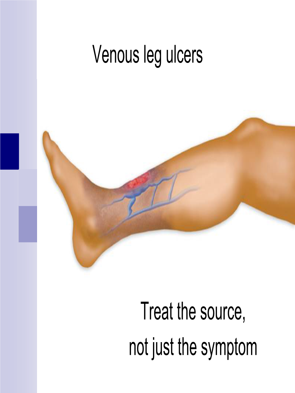 Treat the Source, Not Just the Symptom Venous Leg Ulcers