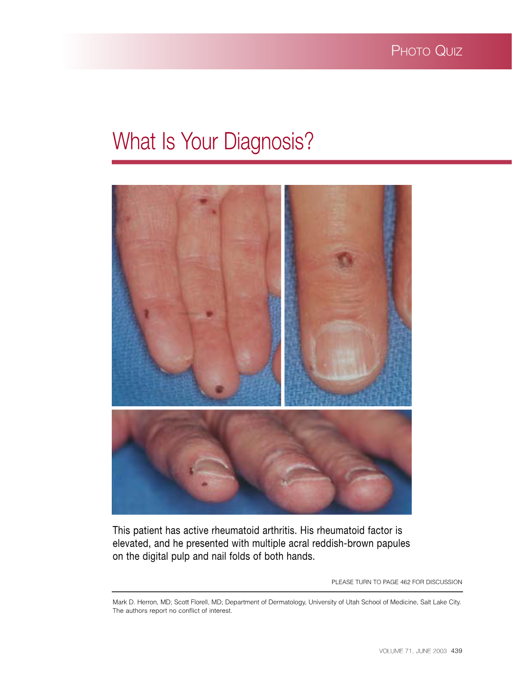 Bywaters Lesions of Rheumatoid Vasculitis