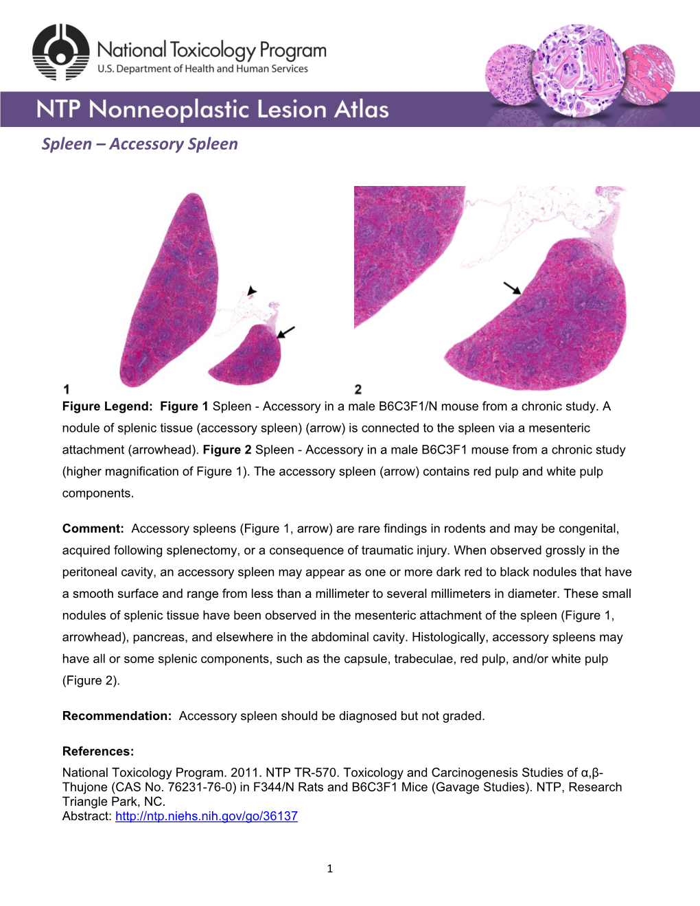 Accessory Spleen