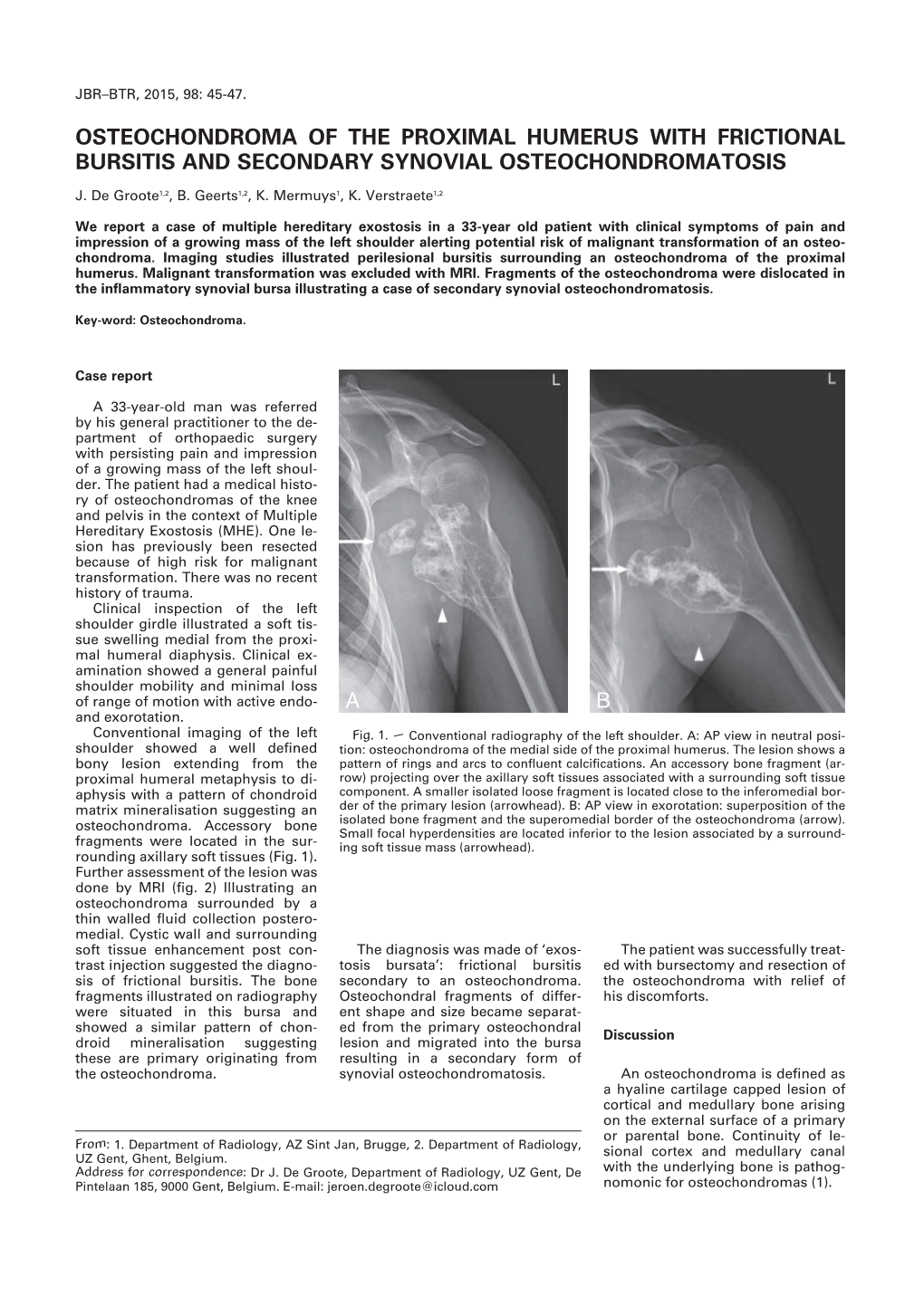 Osteochondroma of the Proximal Humerus with Frictional Bursitis and Secondary Synovial Osteochondromatosis