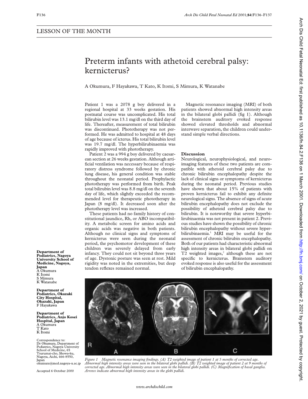 Preterm Infants with Athetoid Cerebral Palsy: Kernicterus?