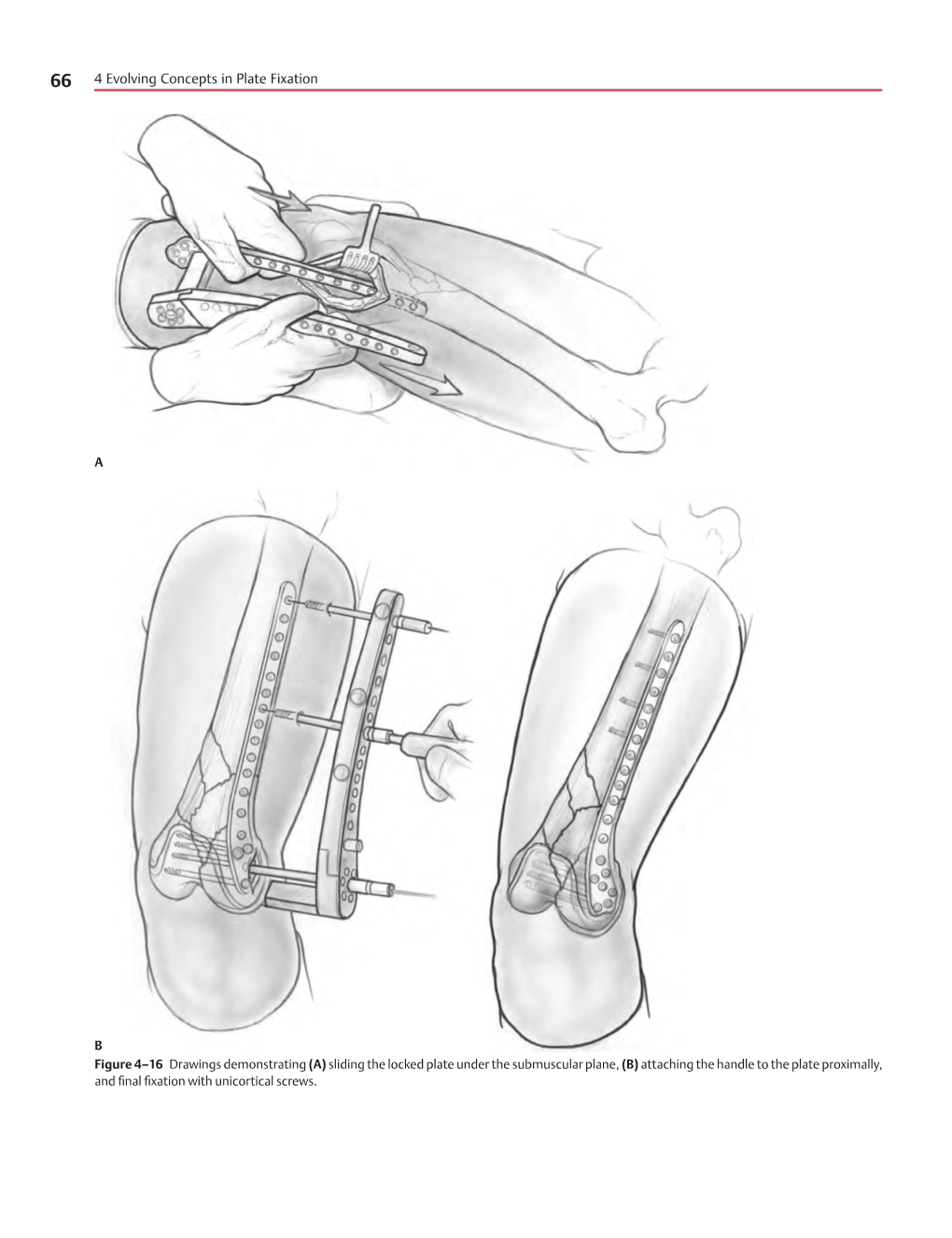 4 Evolving Concepts in Plate Fixation