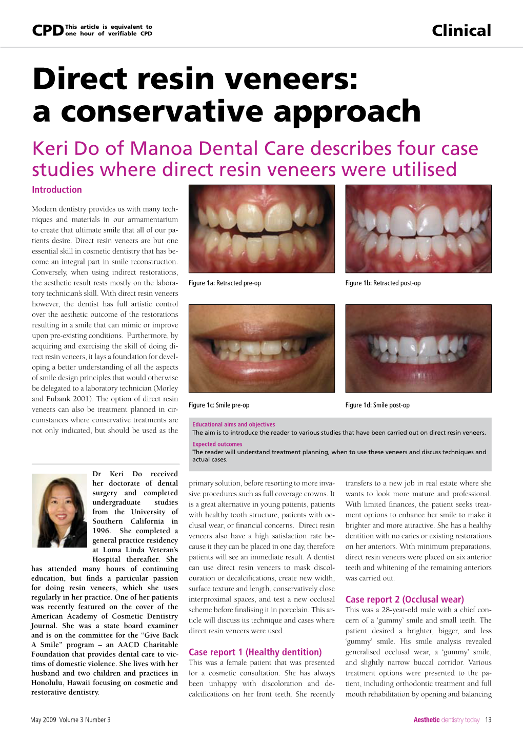 Direct Resin Veneers: a Conservative Approach Keri Do of Manoa Dental Care Describes Four Case Studies Where Direct Resin Veneers Were Utilised Introduction