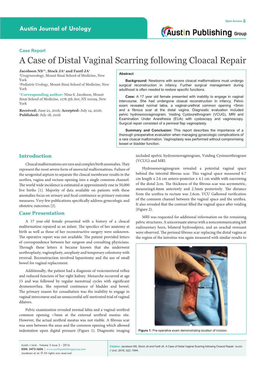 A Case of Distal Vaginal Scarring Following Cloacal Repair