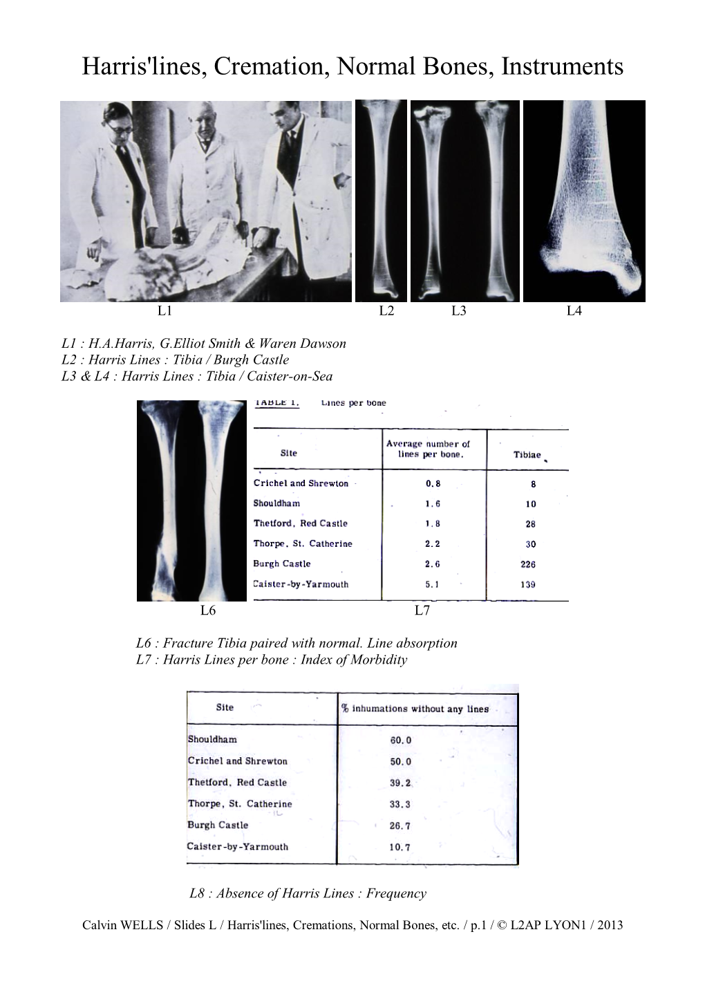 Harris'lines, Mummies, Radiographs, Cremation, Normal Bones