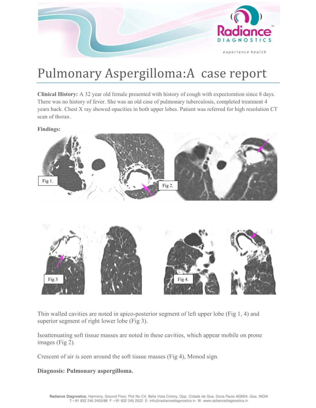 Pulmonary Aspergilloma:A Case Report