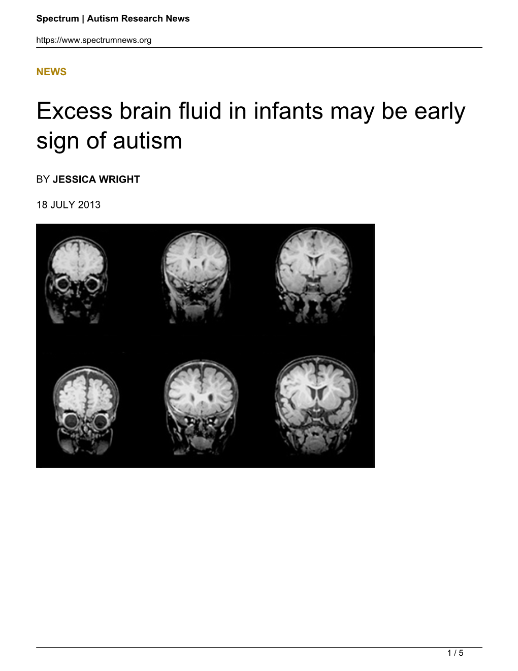 Excess Brain Fluid in Infants May Be Early Sign of Autism