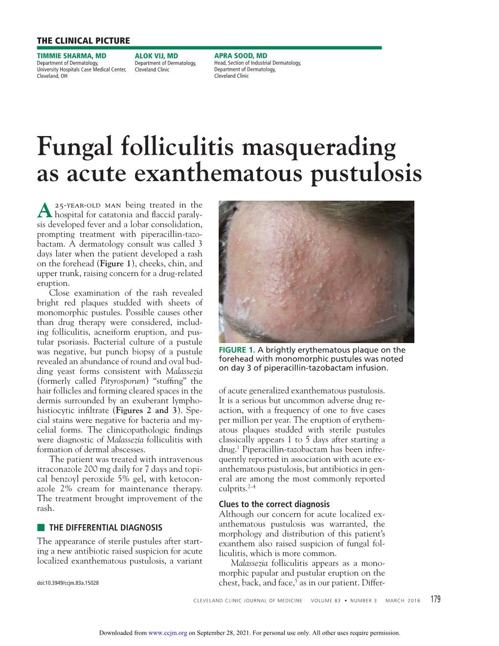 Fungal Folliculitis Masquerading As Acute Exanthematous Pustulosis