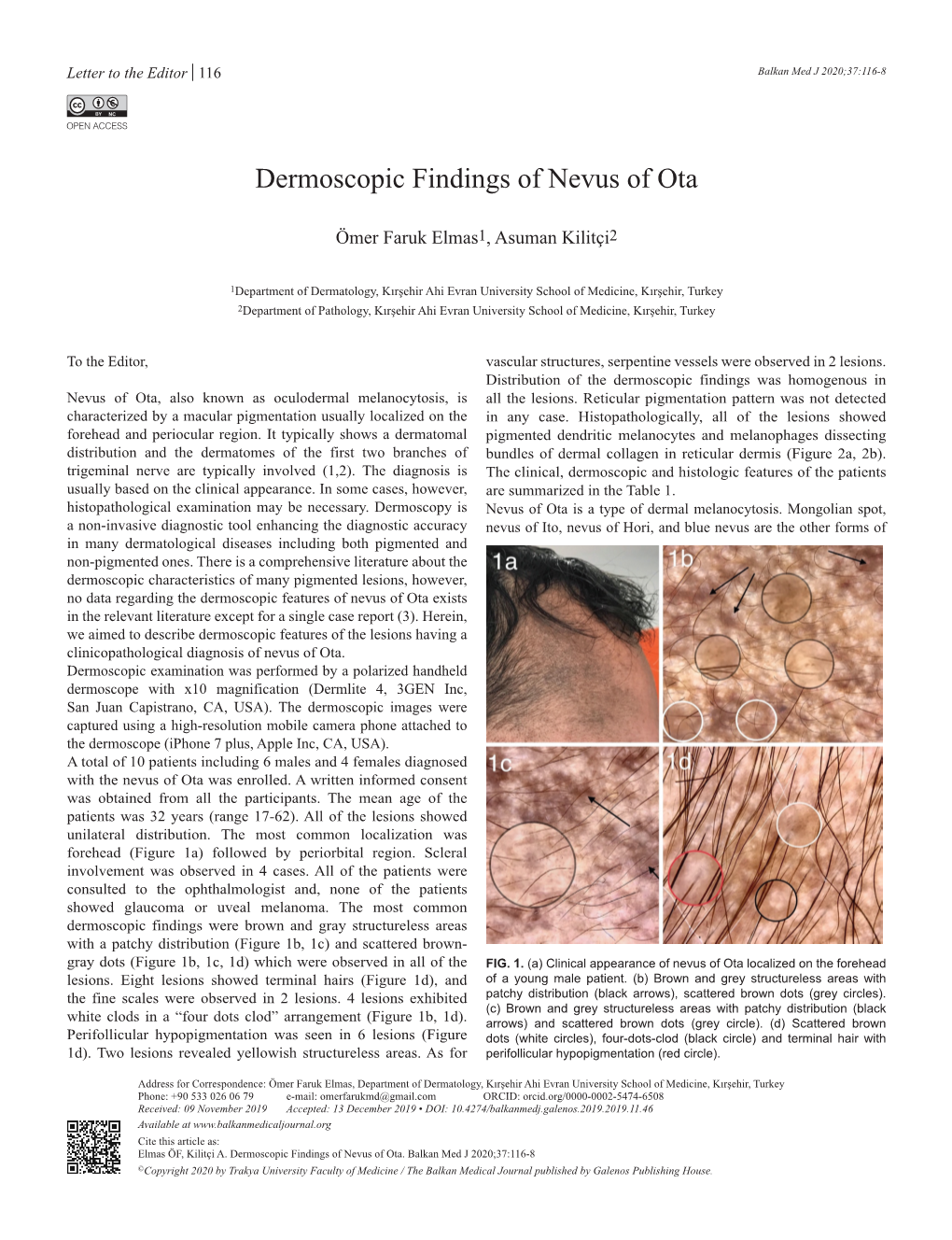 Dermoscopic Findings of Nevus of Ota