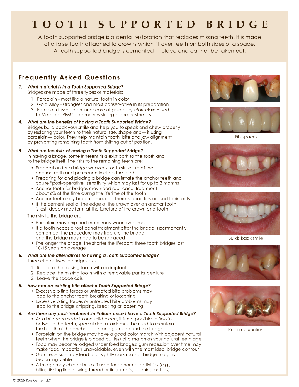 TOOTH SUPPORTED BRIDGE a Tooth Supported Bridge Is a Dental Restoration That Replaces Missing Teeth
