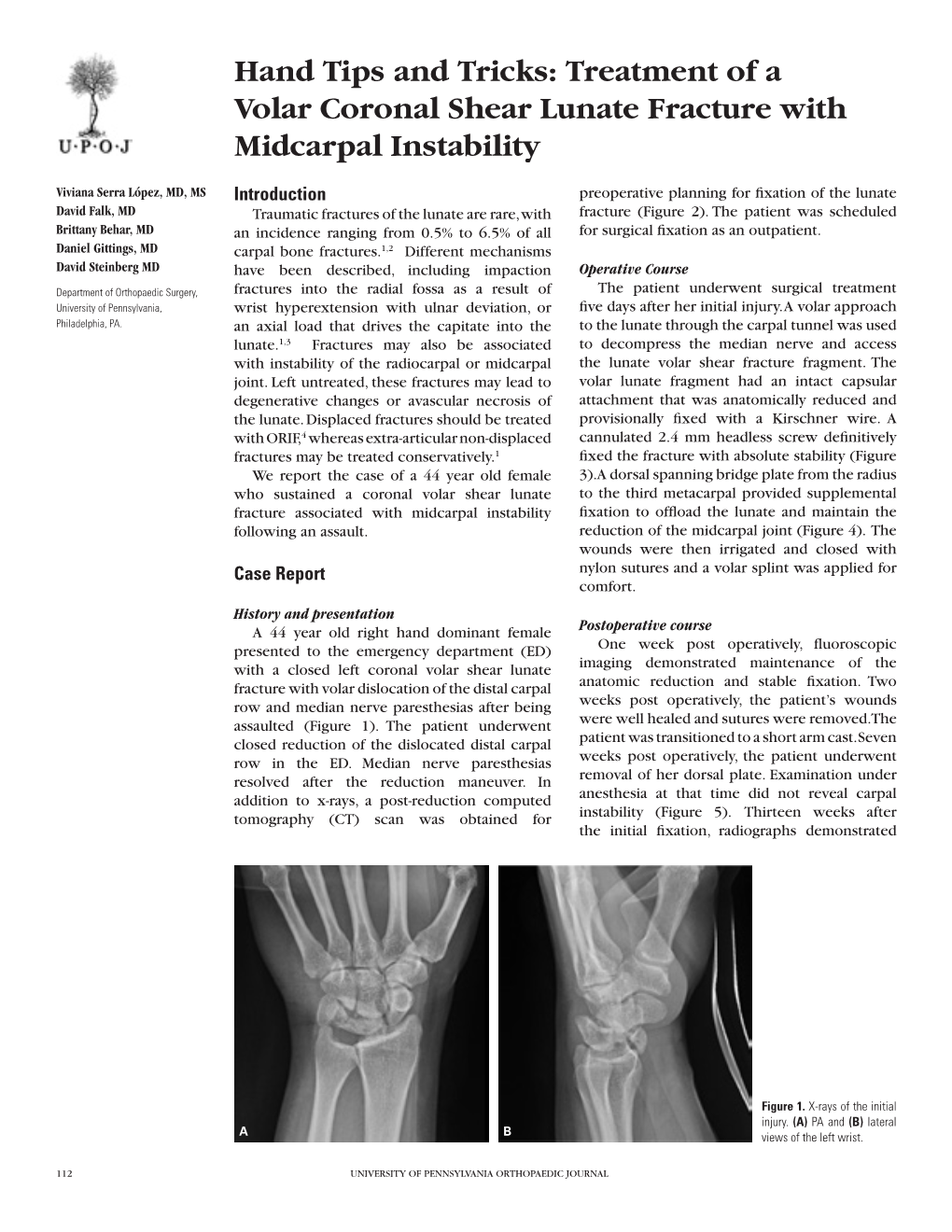 Treatment of a Volar Coronal Shear Lunate Fracture with Midcarpal Instability