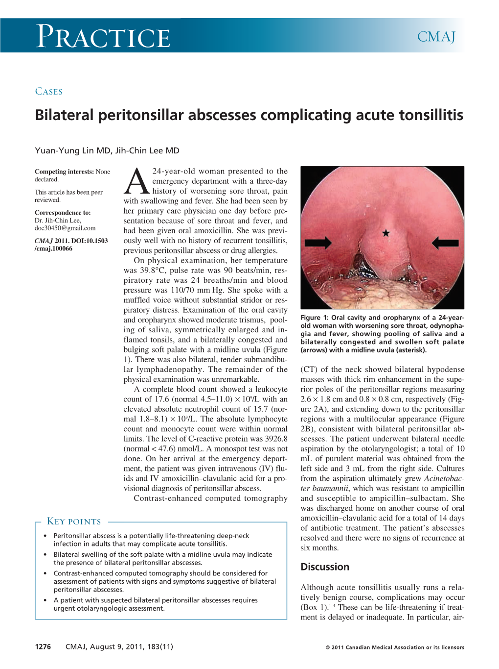 Bilateral Peritonsillar Abscesses Complicating Acute Tonsillitis