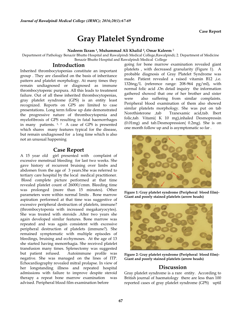 Gray Platelet Syndrome