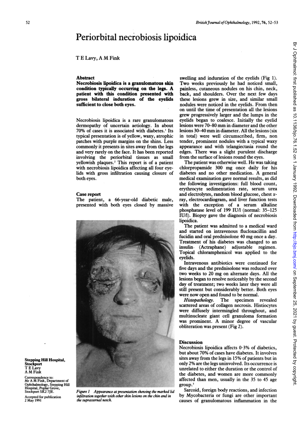 Periorbital Necrobiosis Lipoidica Br J Ophthalmol: First Published As 10.1136/Bjo.76.1.52 on 1 January 1992