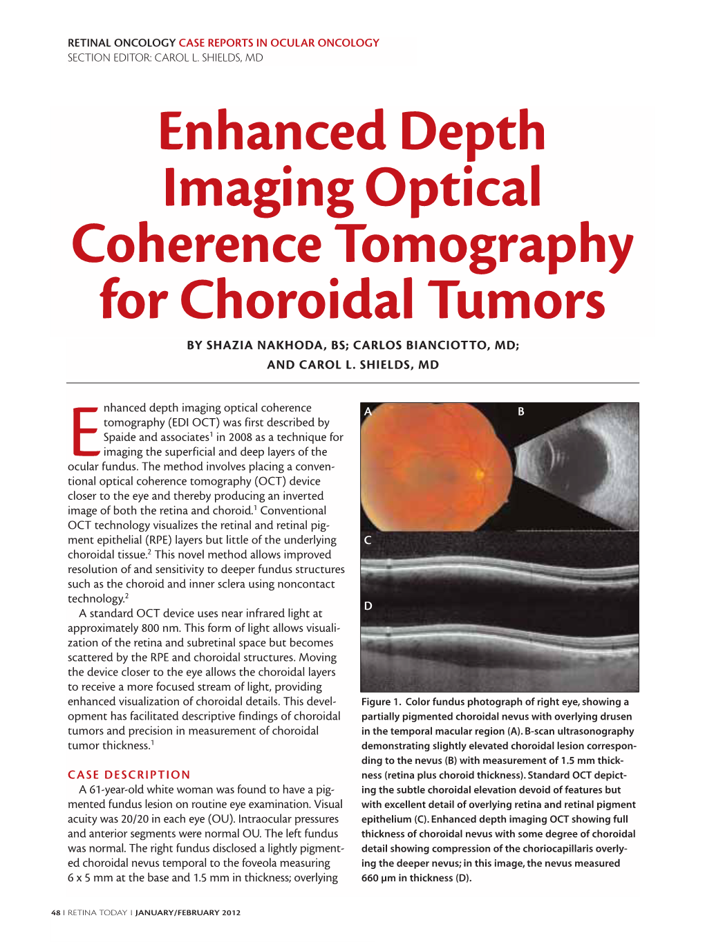 Enhanced Depth Imaging Optical Coherence Tomography for Choroidal Tumors by SHAZIA NAKHODA, BS; CARLOS BIANCIOTTO, MD; and CAROL L