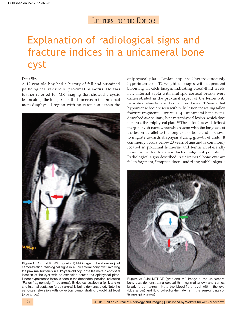 Explanation of Radiological Signs and Fracture Indices in a Unicameral Bone Cyst
