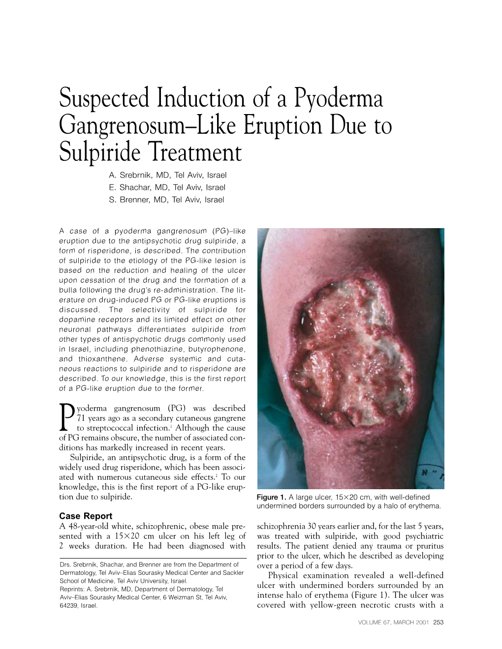 Suspected Induction of a Pyoderma Gangrenosum–Like Eruption Due to Sulpiride Treatment A