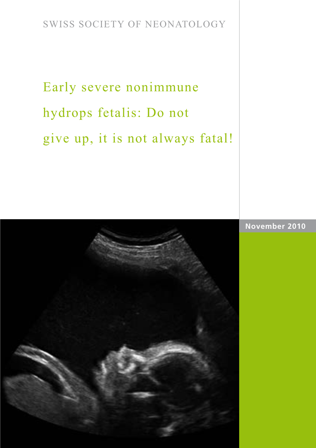 Early Severe Nonimmune Hydrops Fetalis: Do Not Give Up, It Is Not Always Fatal!