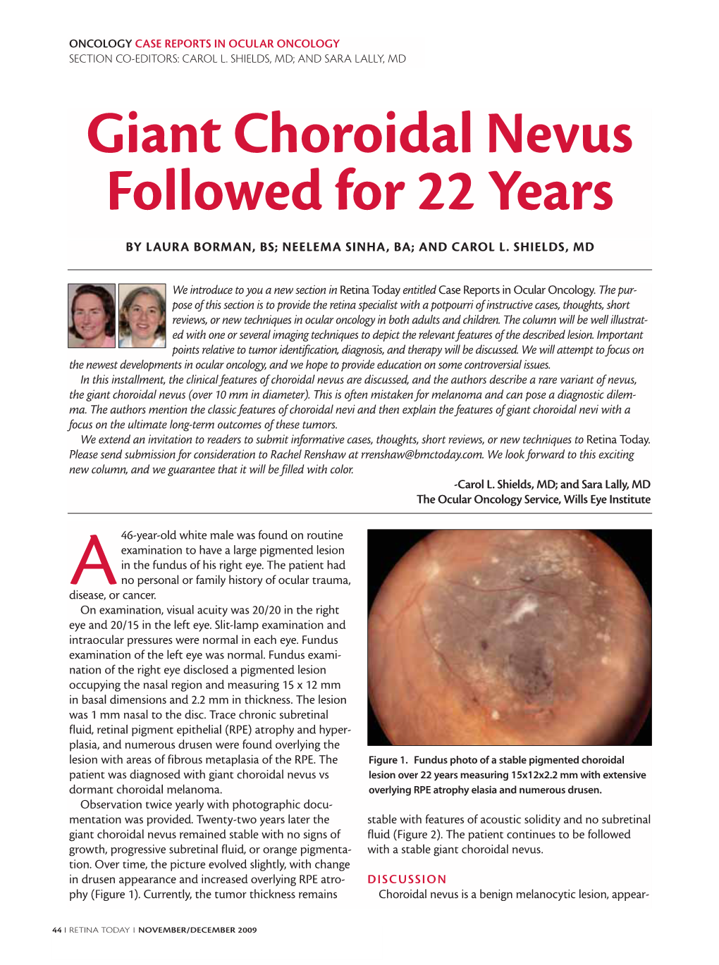 Giant Choroidal Nevus Followed for 22 Years