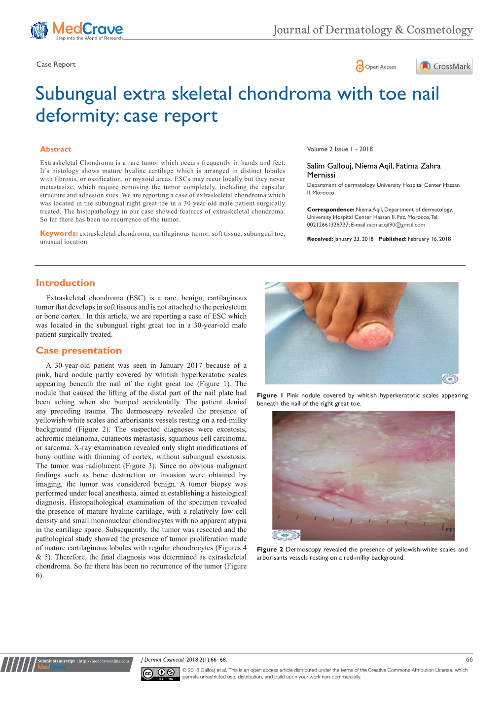 Subungual Extra Skeletal Chondroma with Toe Nail Deformity: Case Report