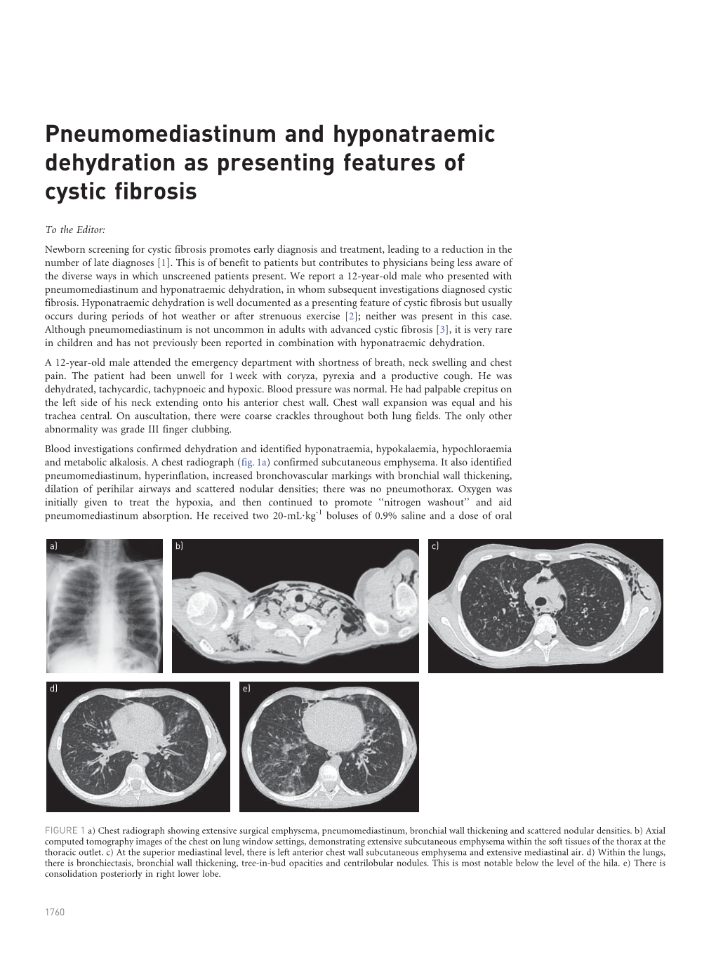 Pneumomediastinum and Hyponatraemic Dehydration As Presenting Features of Cystic Fibrosis