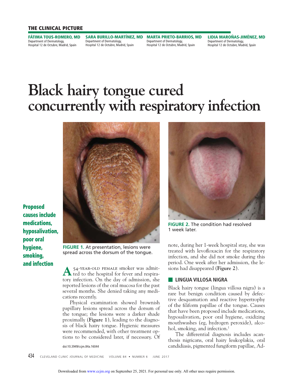 Black Hairy Tongue Cured Concurrently with Respiratory Infection