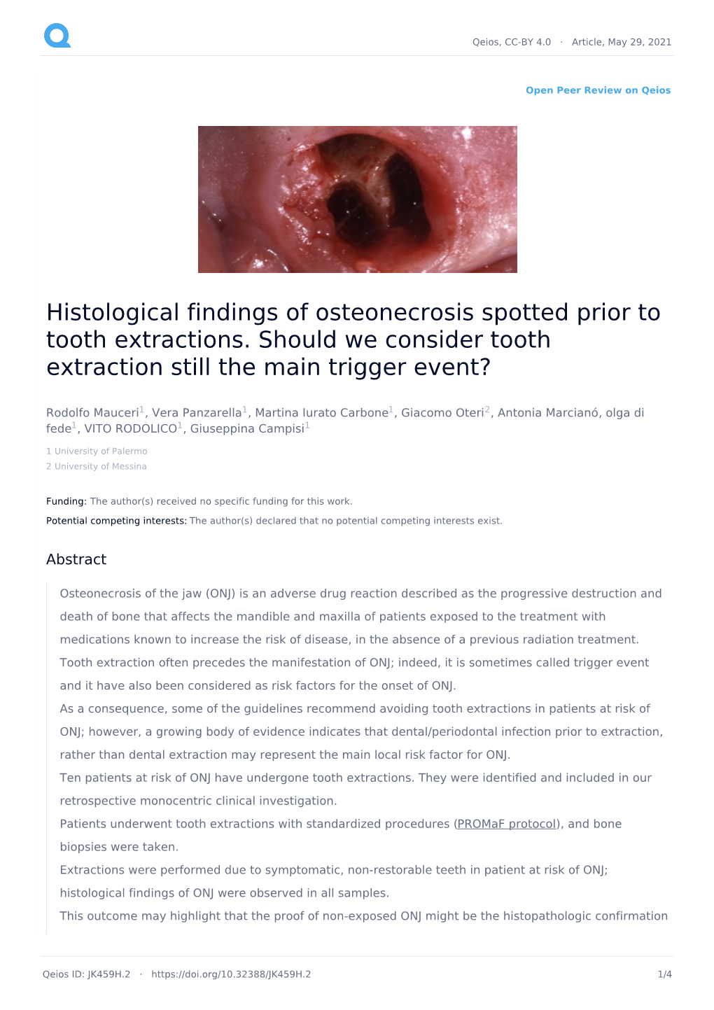Histological Findings of Osteonecrosis Spotted Prior to Tooth Extractions