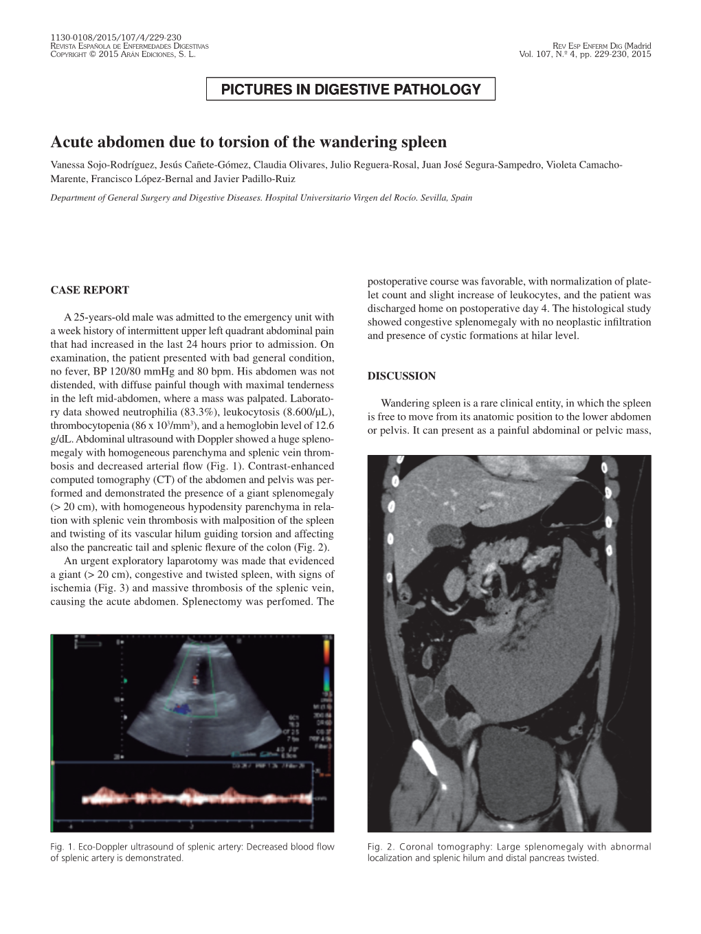 Acute Abdomen Due to Torsion of the Wandering Spleen