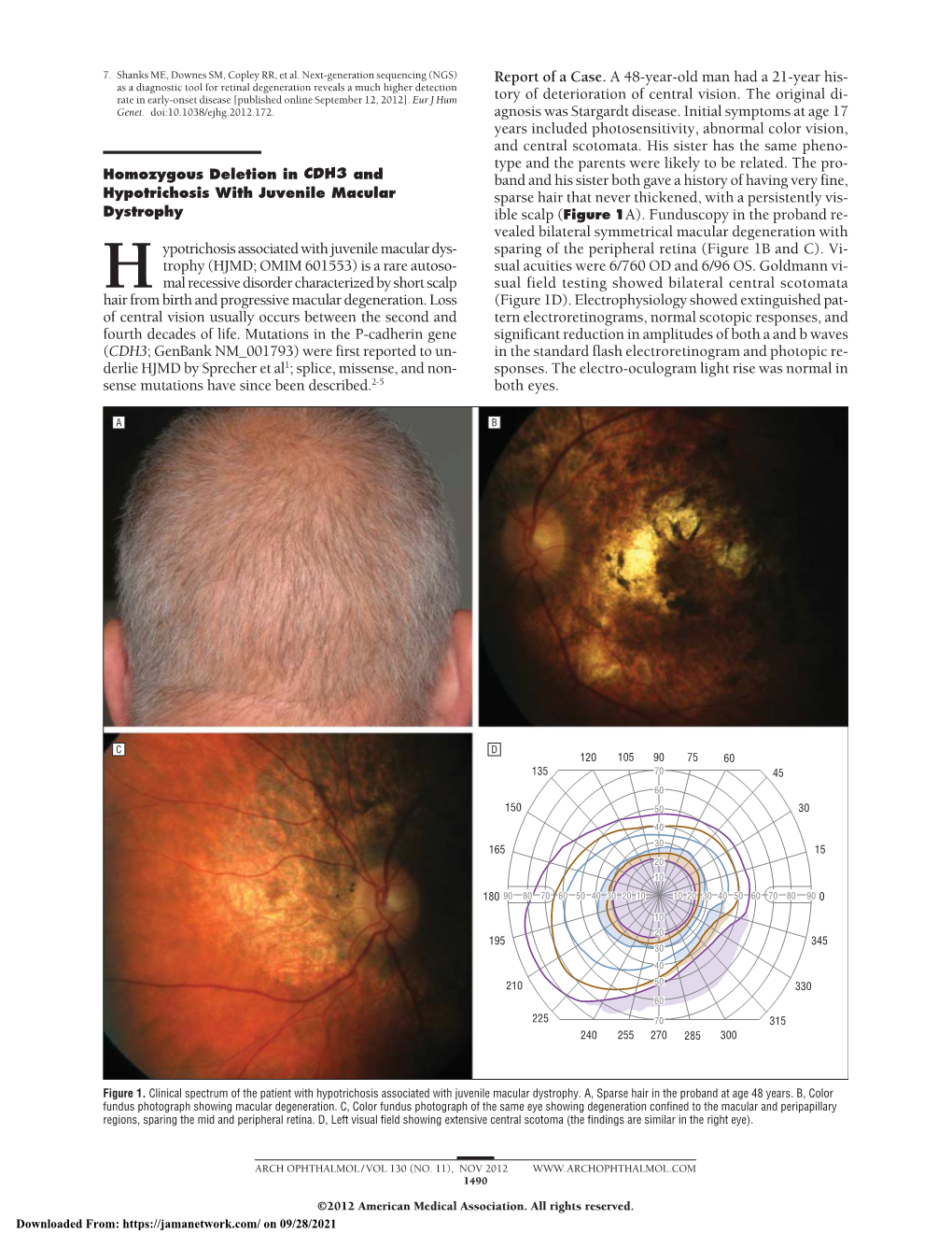 Homozygous Deletion in CDH3 and Hypotrichosis with Juvenile Macular Dystrophy