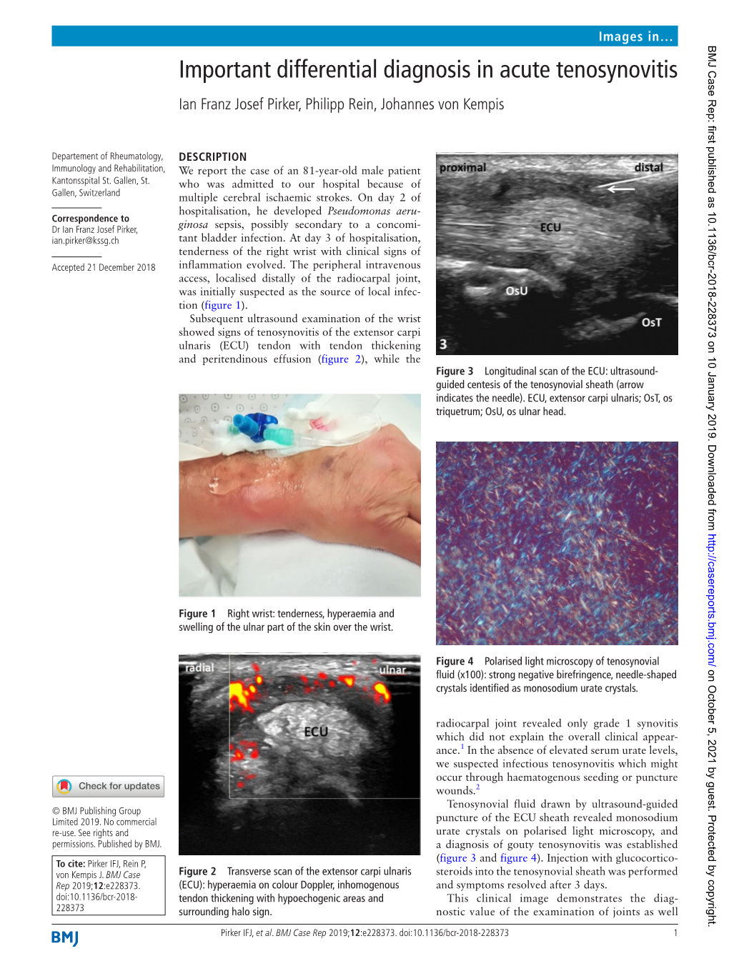 Important Differential Diagnosis in Acute Tenosynovitis Ian Franz Josef Pirker, Philipp Rein, Johannes Von Kempis