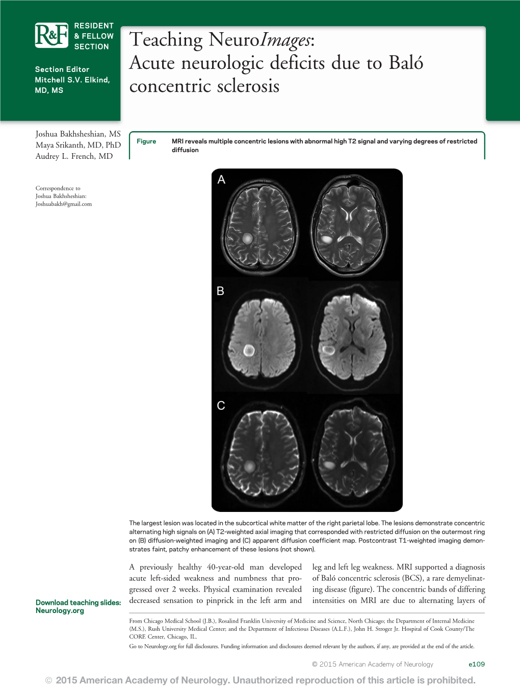 Teaching Neuroimages: Acute Neurologic Deficits Due to Baló Concentric Sclerosis Joshua Bakhsheshian, Maya Srikanth and Audrey L